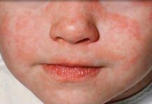 Превантивни мерки срещу епидемията от морбили