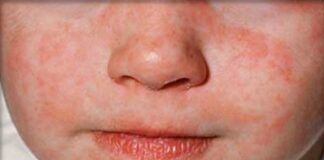 Превантивни мерки срещу епидемията от морбили