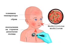 Министерството на здравеопазването призовава да ваксинираме децата си против морбили