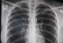 На първи септември в Пловдив ще се извършат безплатни белодробни прегледи