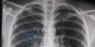 На първи септември в Пловдив ще се извършат безплатни белодробни прегледи