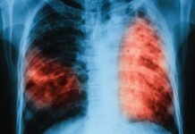 Безплатни прегледи за туберкулоза