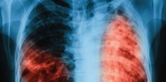 Безплатни прегледи за туберкулоза